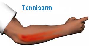 Tennis_arm